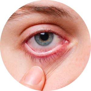 Dry Eye